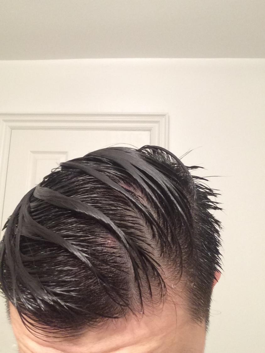 I Think Baking Soda Permanently Destroyed My Hair BaldTruthTalkcom