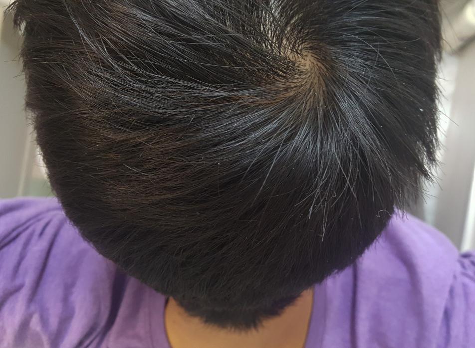 Balding runs in family. Balding only in the crown? 