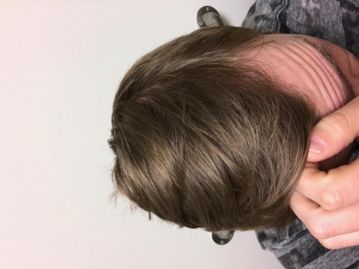Finasteride 5mg How To Cut It
