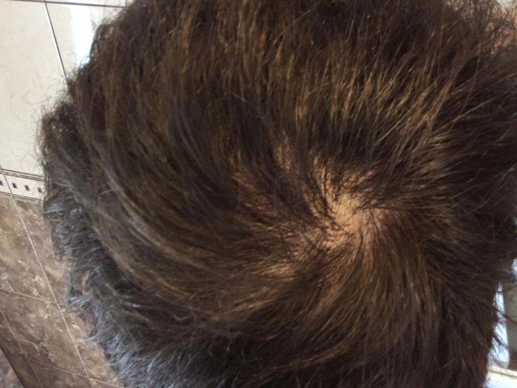Am I Balding At The Crown Baldtruthtalk Com