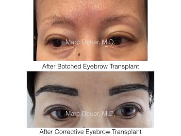 corrective eyebrow transplant