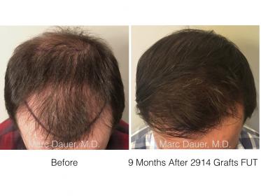 Patient hair transplant result of Dr. Marc Dauer.