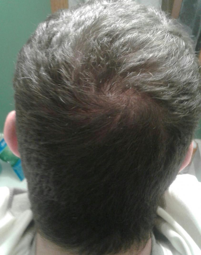 Early Stages Of Balding Baldtruthtalk Com