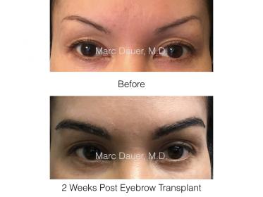 eyebrow transplant photos of a patient of Dr. Marc Dauer