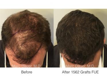 1562 grafts FUE performed by Dr. Marc Dauer