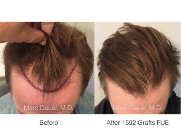Dr. Marc Dauer hair transplant photos