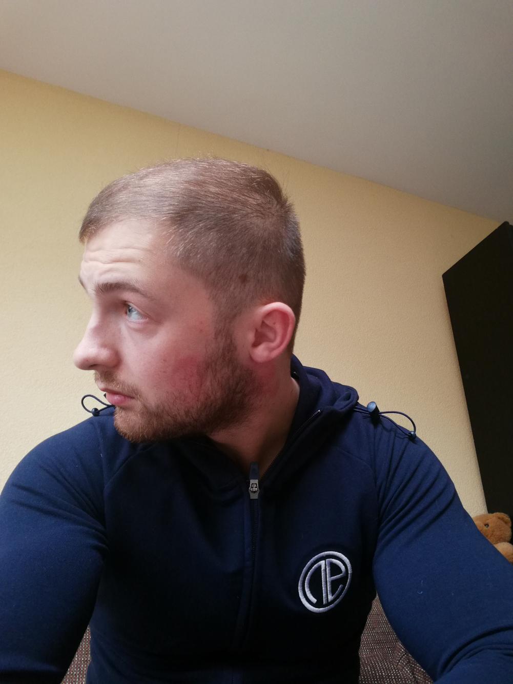 Should I Buzzcut 24yrs Baldtruthtalk Com