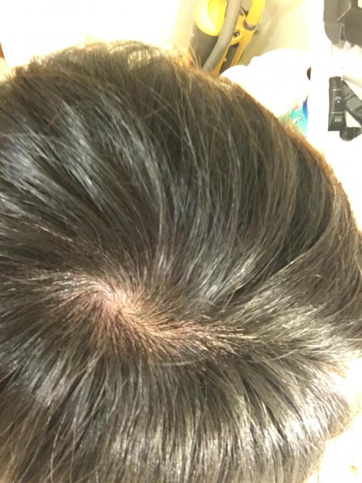 Thinning Around Crown Sign Of Balding Baldtruthtalk Com