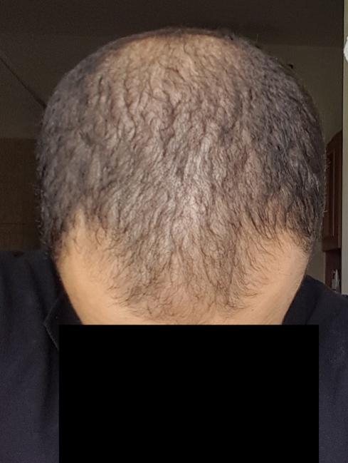 Thin Donor Area Can I Still Get A Ht Baldtruthtalk Com