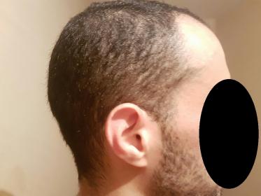 Thin Donor Area Can I Still Get A Ht Baldtruthtalk Com