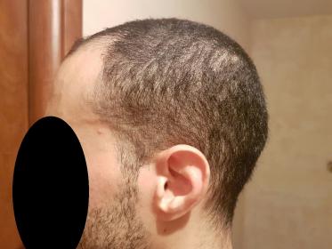 Thin donor area, can I still get a HT? 