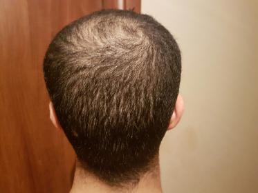 Thin donor area, can I still get a HT? 