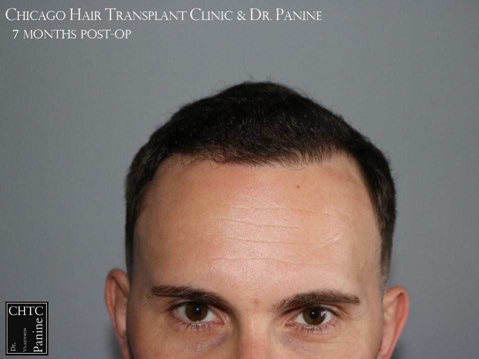 PANINE, MD FUE Hair Transplant Results