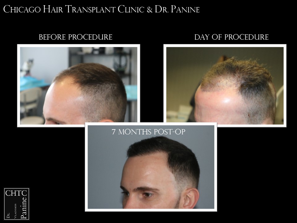 PANINE, MD FUE Hair Transplant Results