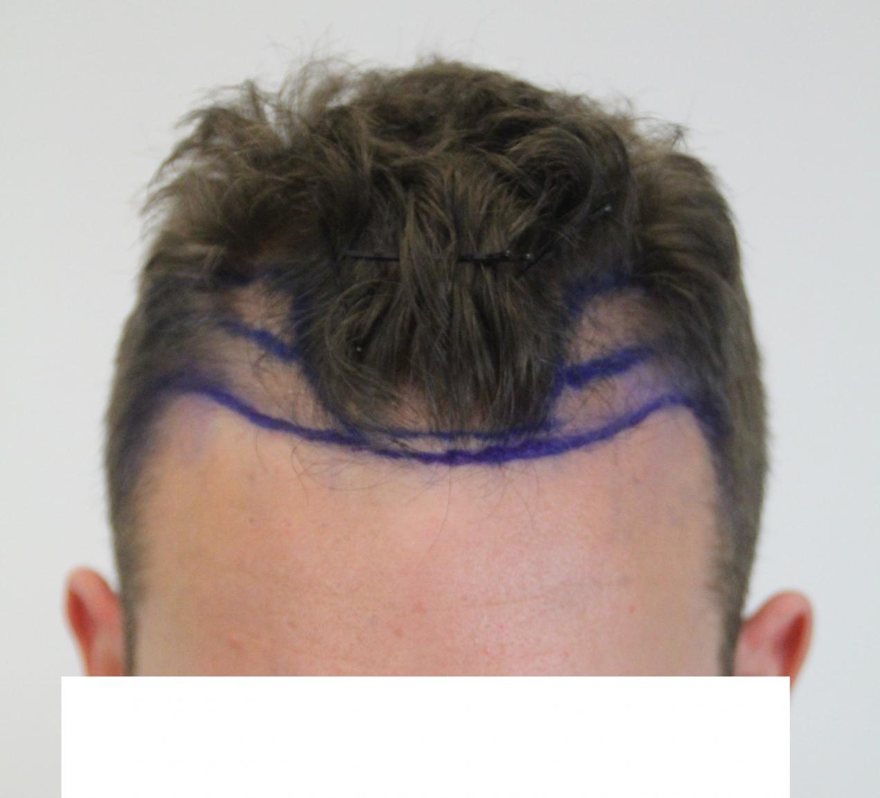 1900 FUE grafts with Dr. Rahal - So happy with my decision! -  
