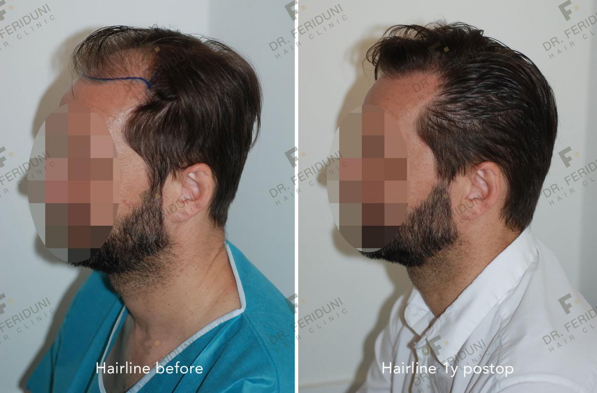 Image uploaded by: Dr Feriduni Hair Clinic