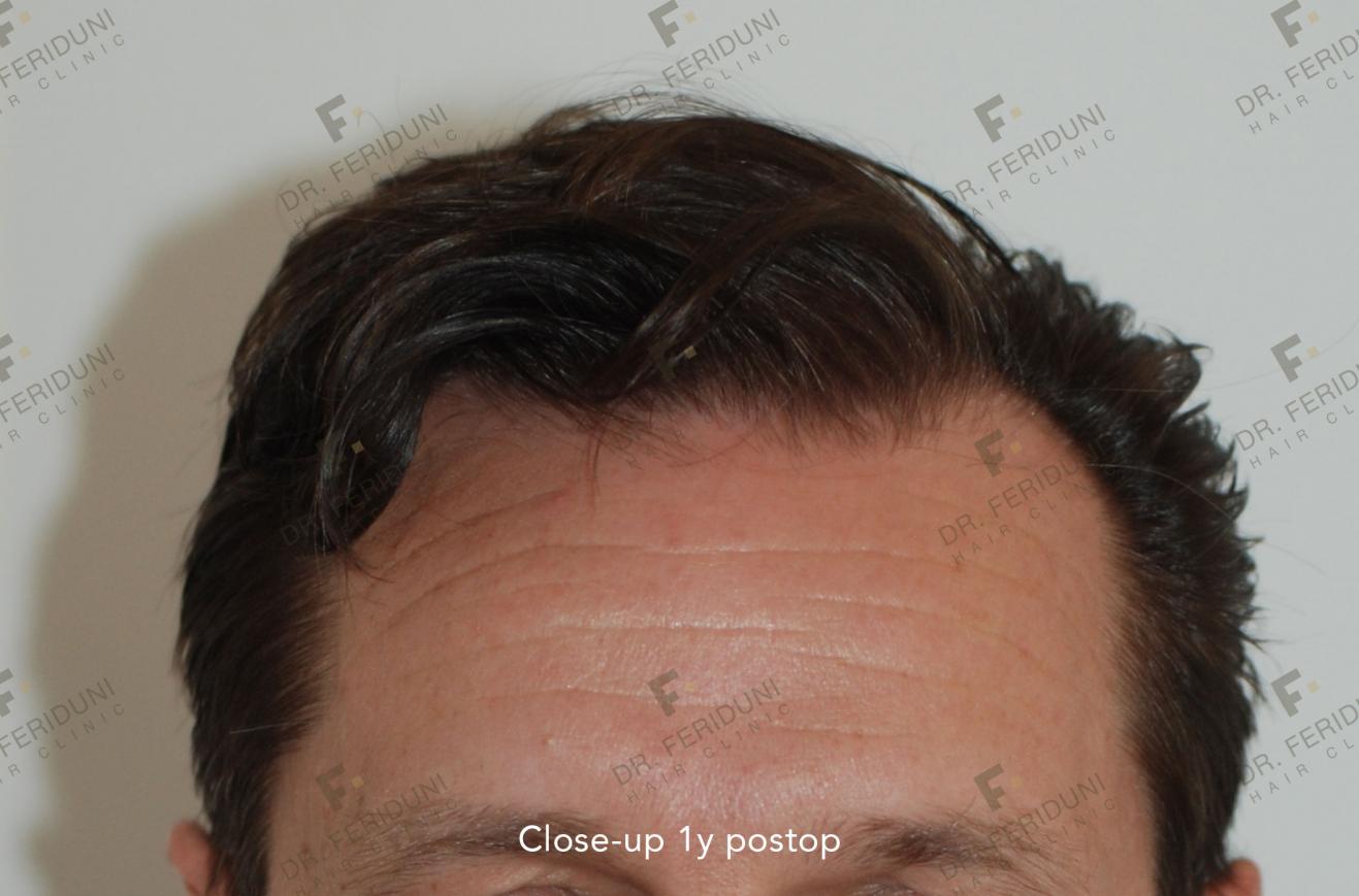 Image uploaded by: Dr Feriduni Hair Clinic