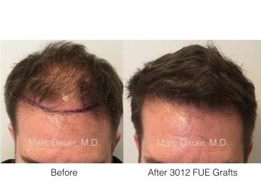 Marc Dauer, MD- 3012 FUE Grafts