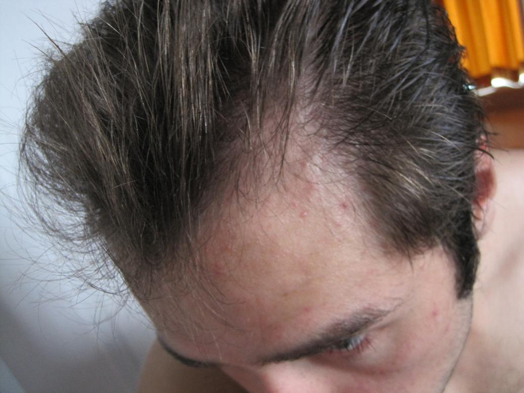 Need Help With Receding Hairline With Pics Baldtruthtalk Com