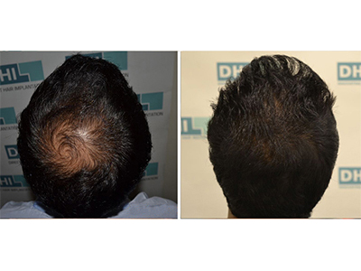 mohit setia, 4026 hair, 10 months result