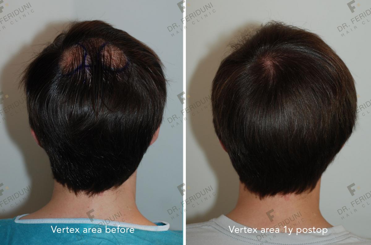 Image uploaded by: Dr Feriduni Hair Clinic