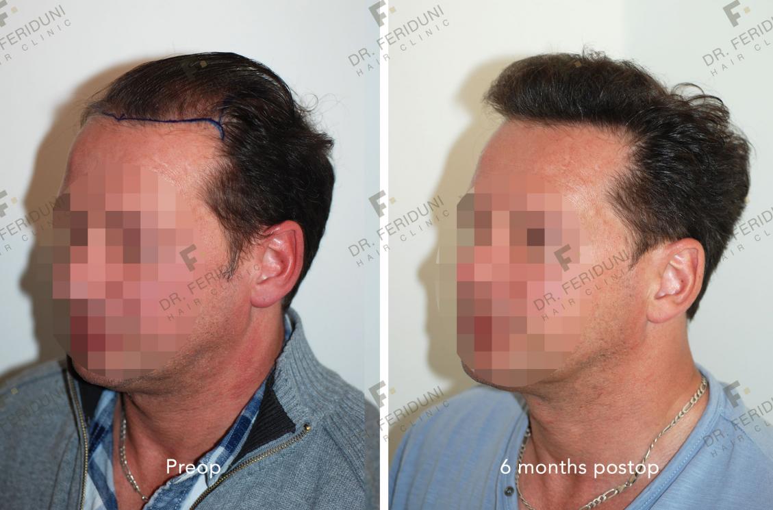 Image uploaded by: Dr Feriduni Hair Clinic