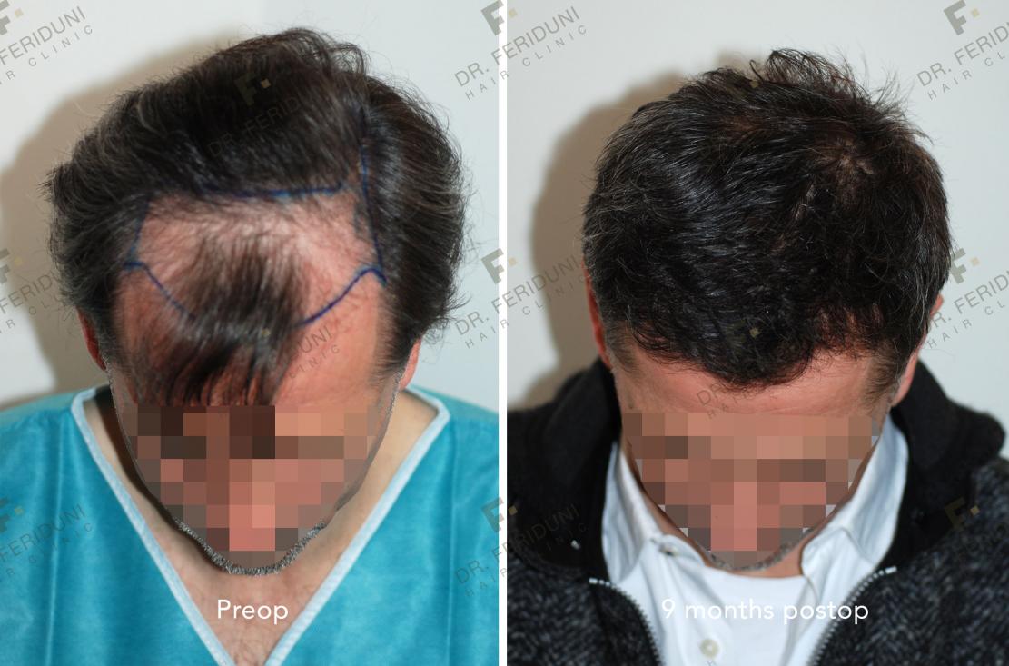 Image uploaded by: Dr Feriduni Hair Clinic