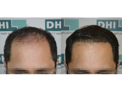 Piyush Mohan 3754 Hair Impanted 6 Mnth Result