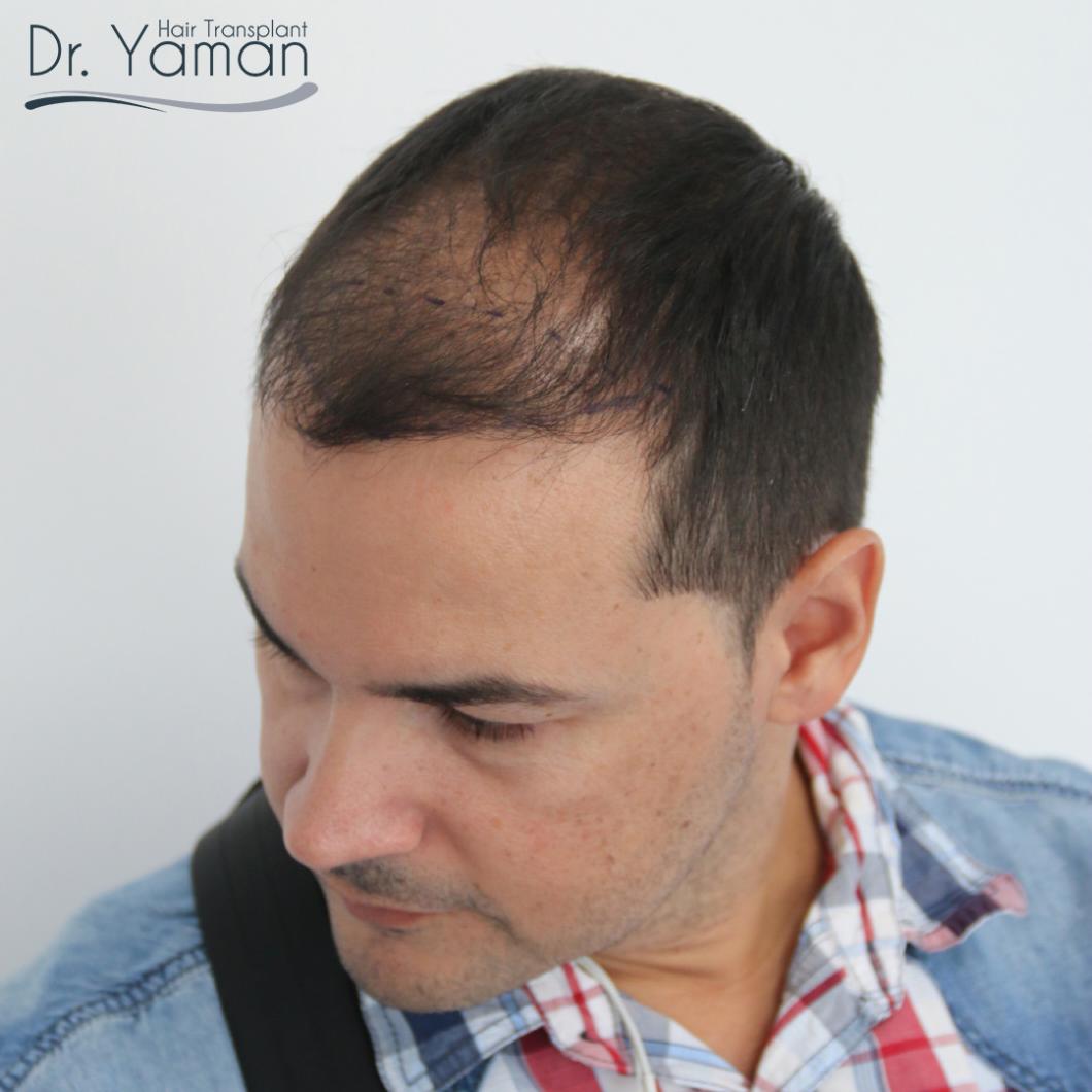 Dr Resul Yaman Hair Clinic 4150 Grafts Result Baldtruthtalk Com