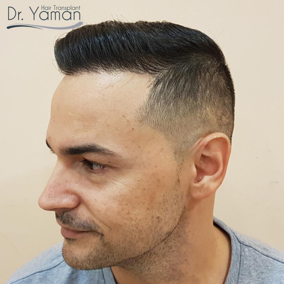 Dr Resul Yaman Hair Clinic 4150 Grafts Result Baldtruthtalk Com