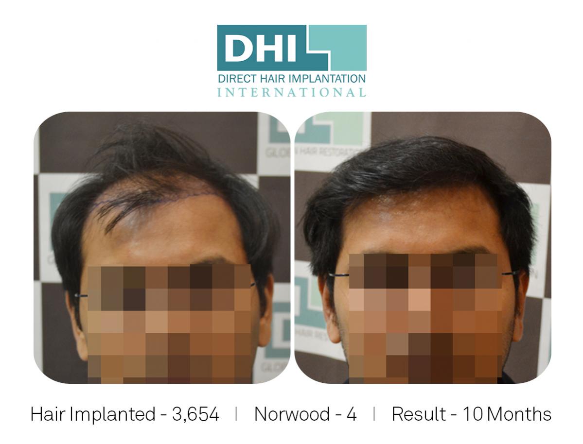 Norwood 4, Hair Implanted 3654