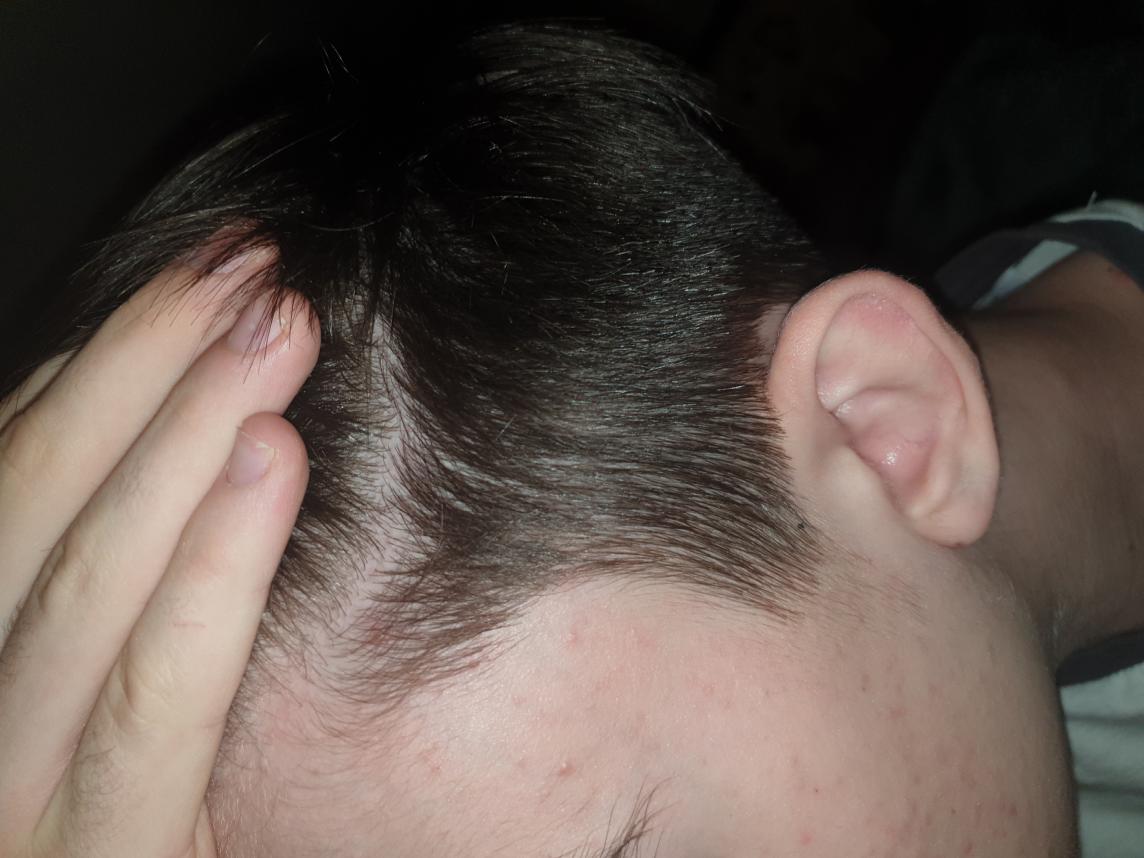 Am I balding or just normal hair parting? 