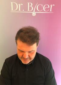 ZLEM BİCER 4080 GRAFTS FUE+PRP