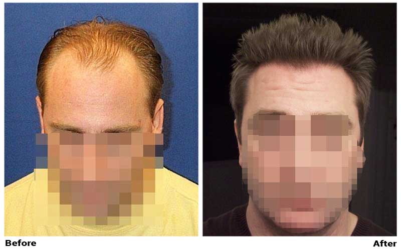 Patient "Wassup" - FUE - 5600 Grafts -3 sessions