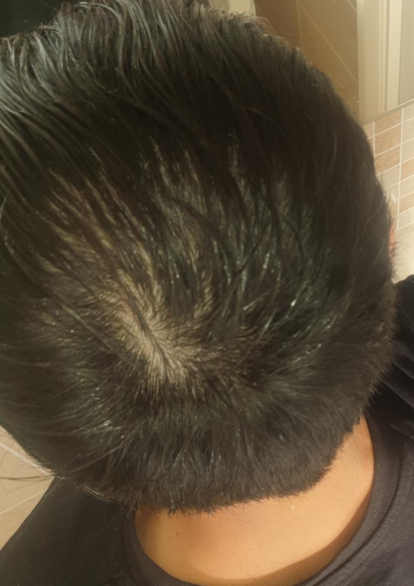 Crown thinning? - BaldTruthTalk.com