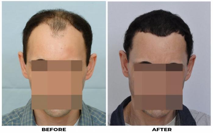 FUE hair restoration - Norwood 4 - 2500 grafts