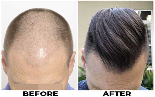 Click image for larger version

Name:	hair-transplant-Before-After.jpg

Size:	20.0 KB
ID:	67867