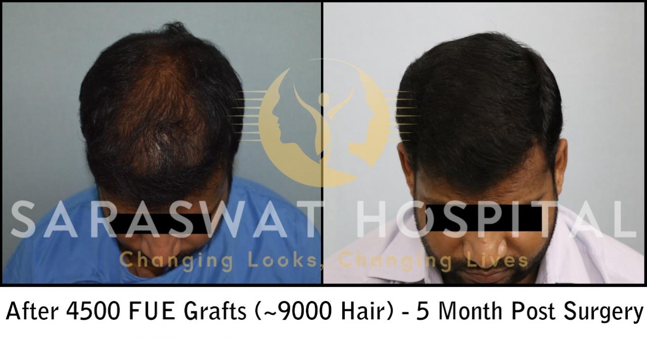 Repair Hair Transplant Results in Agra