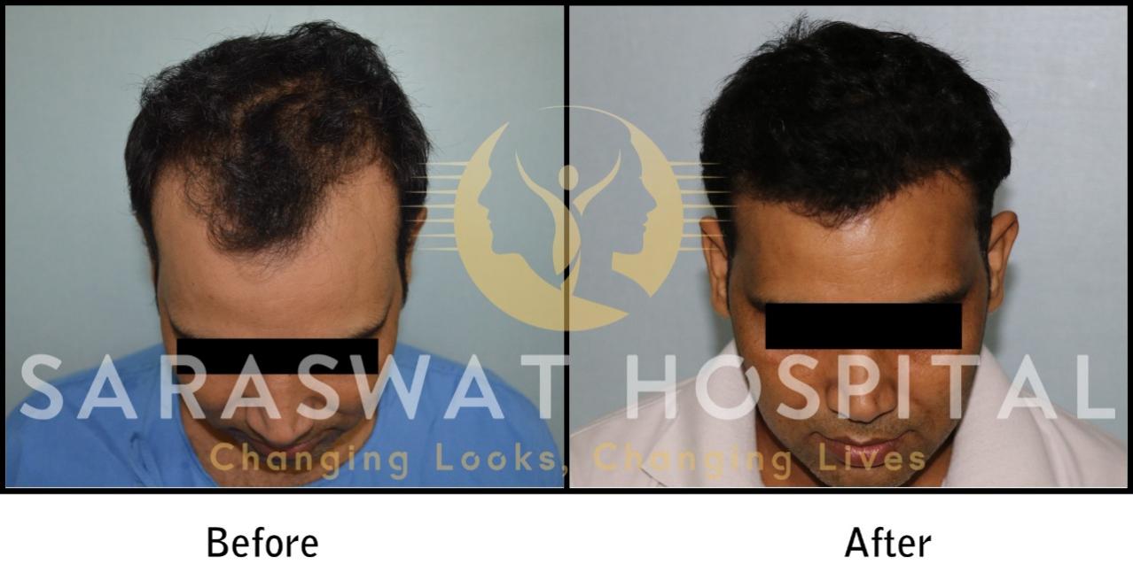 Hair Transplant Surgery Results at Saraswat Hospital