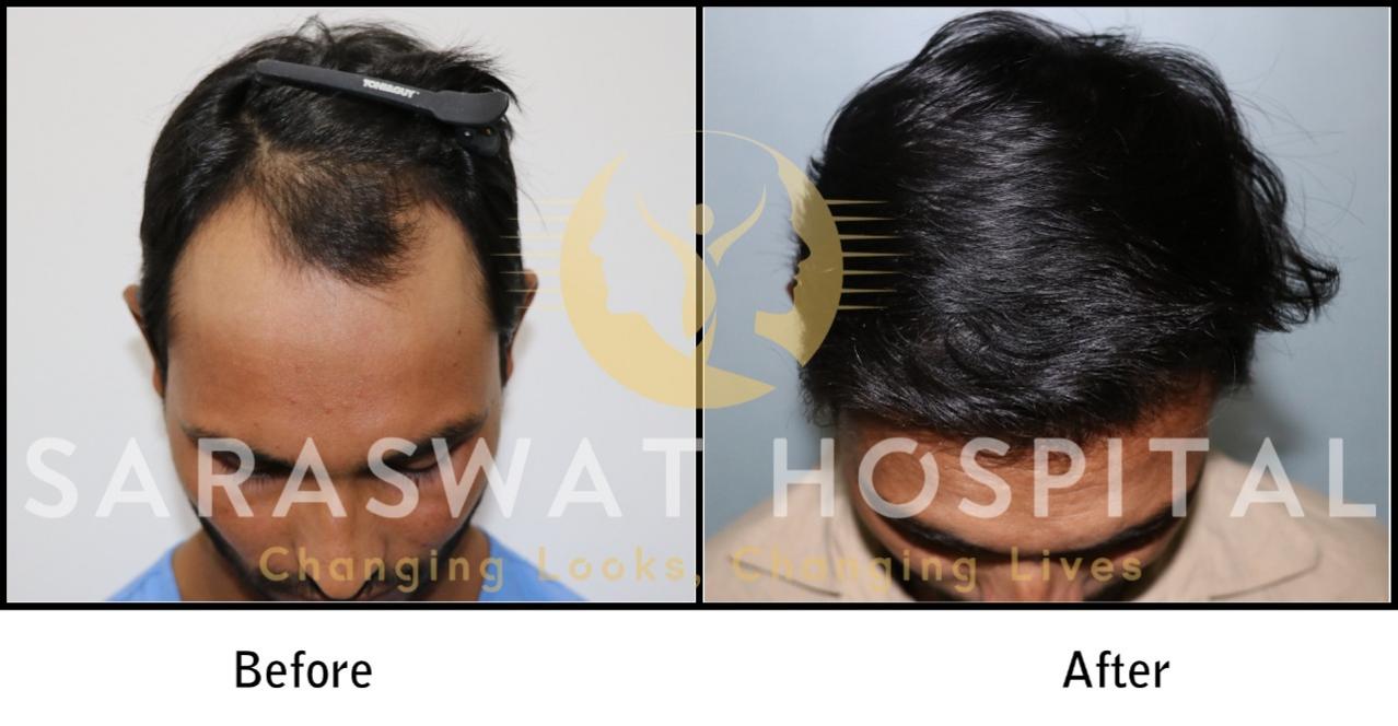 Hair Transplant Results Agra