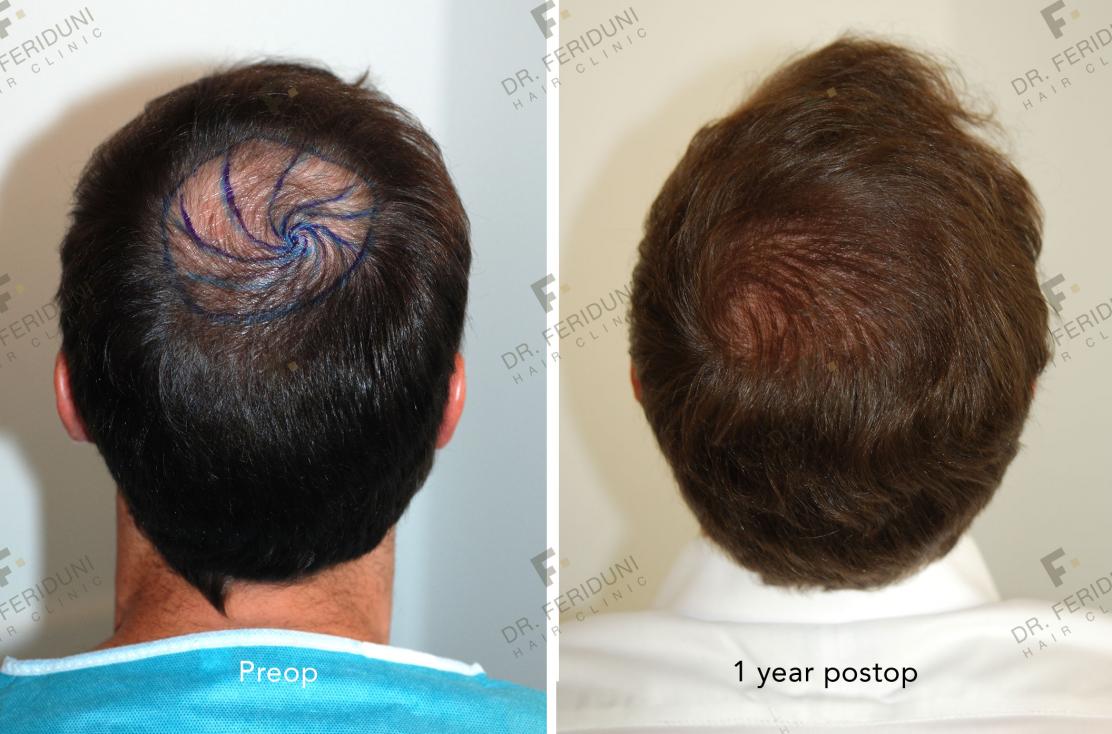 Image uploaded by: Dr Feriduni Hair Clinic