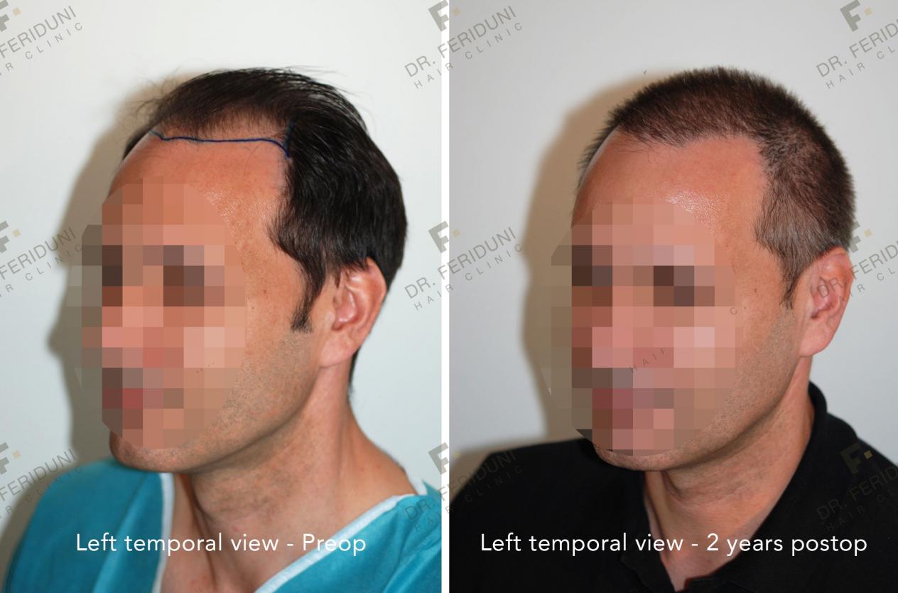 Image uploaded by: Dr Feriduni Hair Clinic