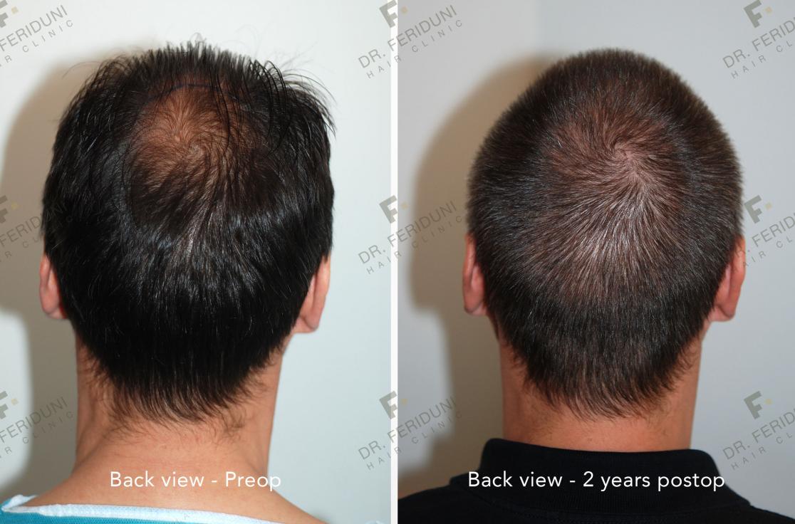 Image uploaded by: Dr Feriduni Hair Clinic