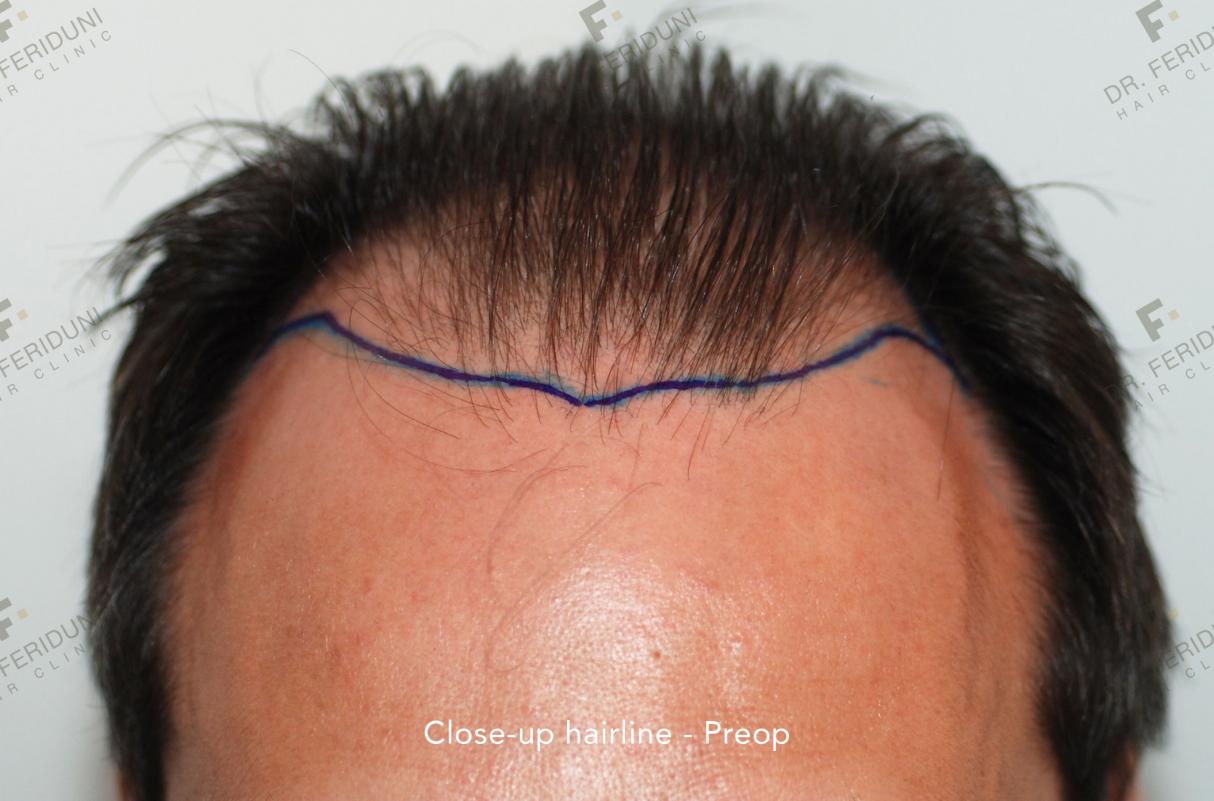 Image uploaded by: Dr Feriduni Hair Clinic