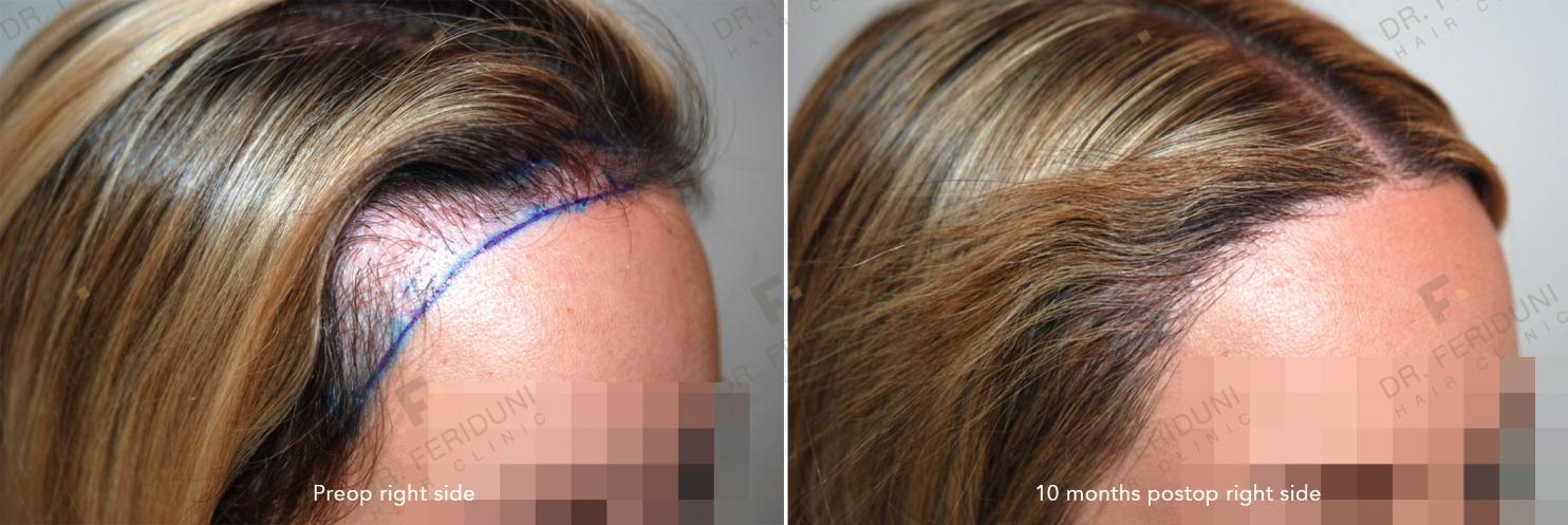 Image uploaded by: Dr Feriduni Hair Clinic