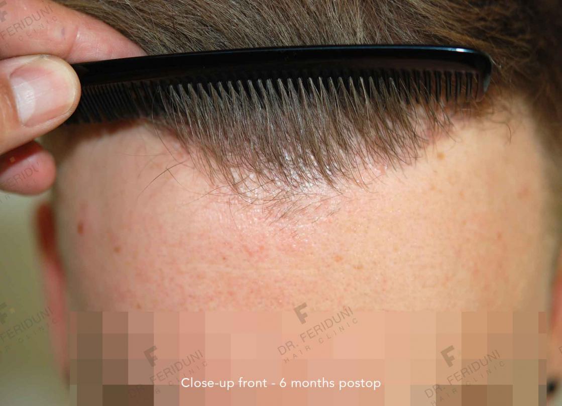 Image uploaded by: Dr Feriduni Hair Clinic