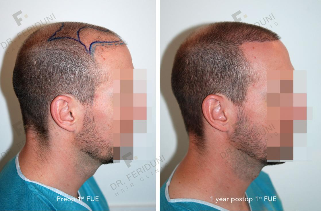Image uploaded by: Dr Feriduni Hair Clinic