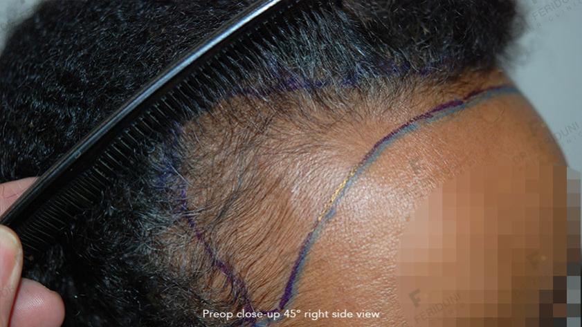 Image uploaded by: Dr Feriduni Hair Clinic