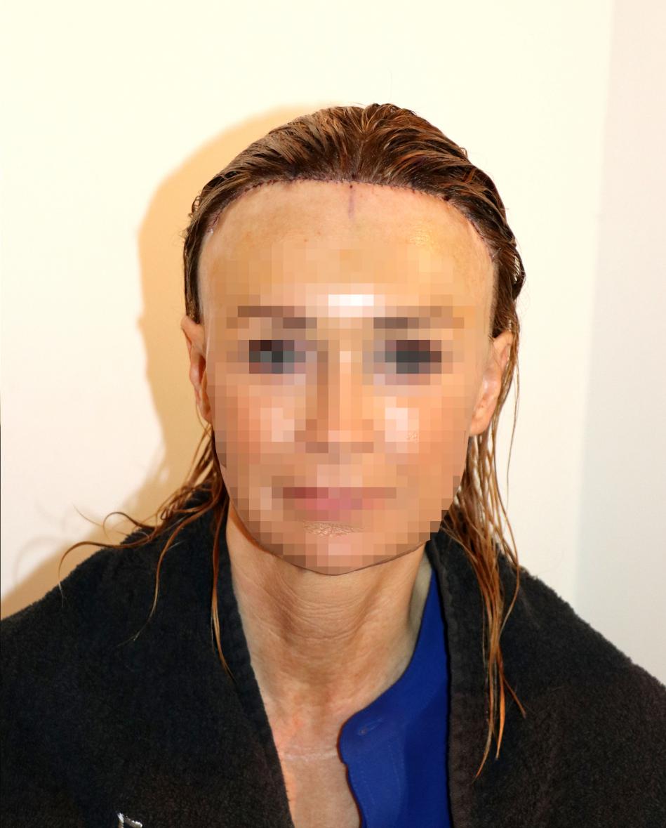 Image uploaded by: Dr Feriduni Hair Clinic