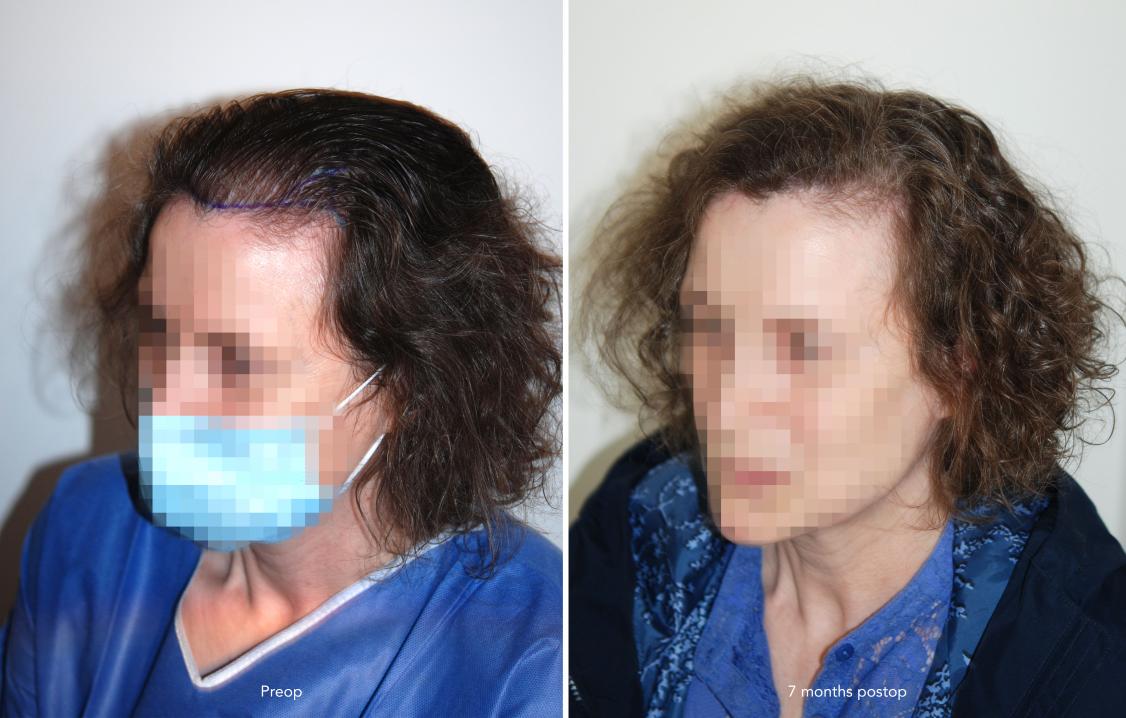 Image uploaded by: Dr Feriduni Hair Clinic